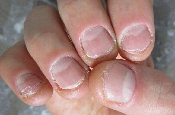 nagelbijten2.jpg.3e6e33b394de5bc802578f947dd2cb2d.jpg